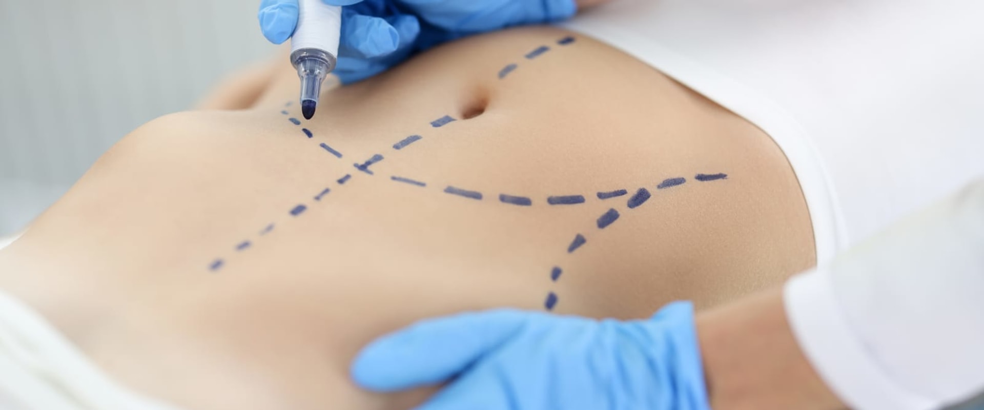 Exploring Functional Medicine and Liposuction Costs in AZ